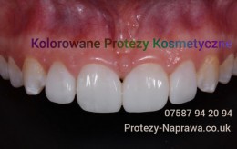 07587 94 20 94,Naprawy Protez Dentystycznych w Londynie,Naprawa Protez Dentystycznych w Londynie, Polska Pracownia Protetyczna w Londynie,Uslugi Protetyczne w londynie,Dostawianie zebow w londynie,Polski Protetyk w Londynie, polski protetyk londyn,protezy